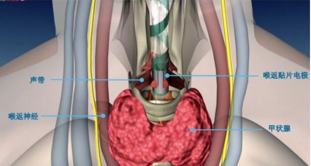 海神“喉返贴片电极”横空出世！解决喉返神经损伤问题