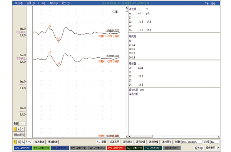 093波形图-前庭诱发