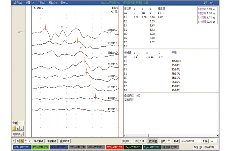 093波形图-听觉诱发-脑干听阙
